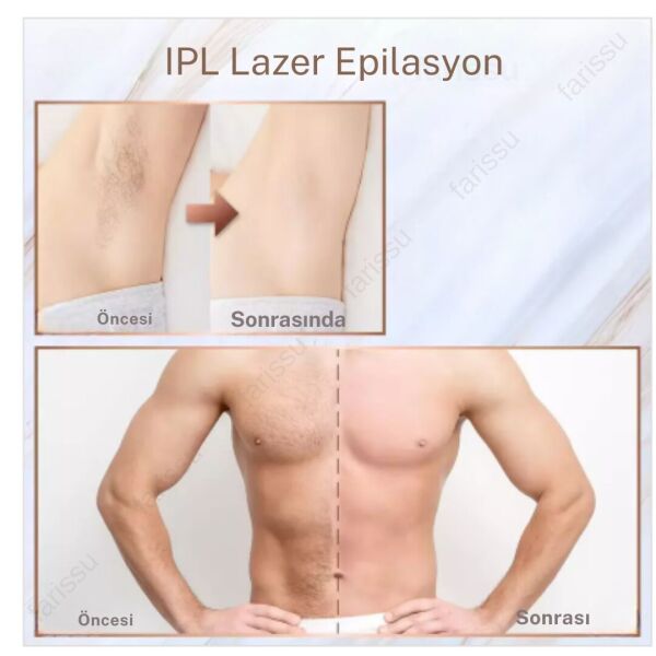 Trend Farma hediyeli Soğuk Buz İpl Lazer Epilasyon Cihazı - 999.999 Atım,  Ağrısız buz lazer